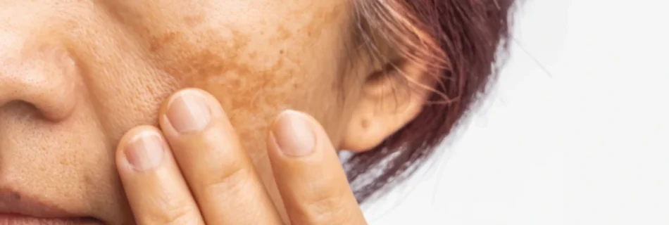 woman with melasma