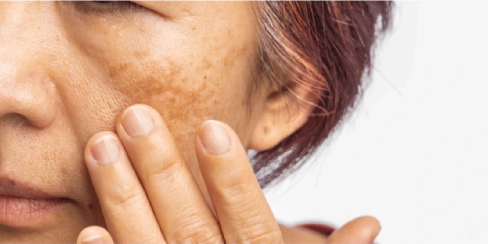 woman with melasma