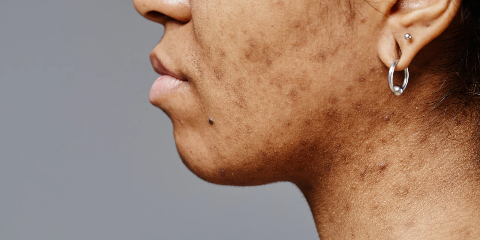 Woman with acne scars