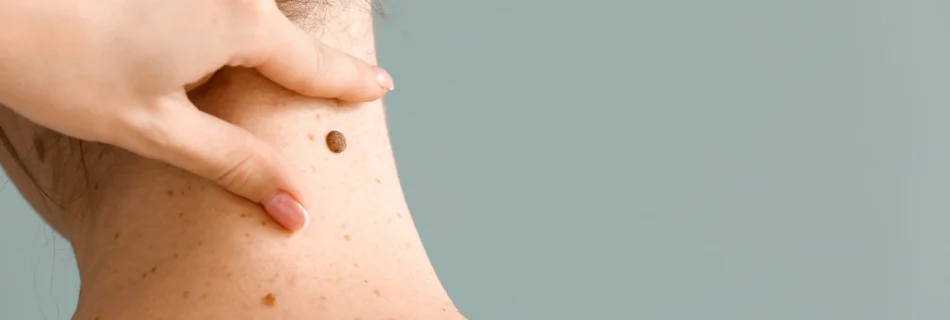 Close-up image of a person’s neck showing multiple moles being examined by a healthcare professional before mole removal