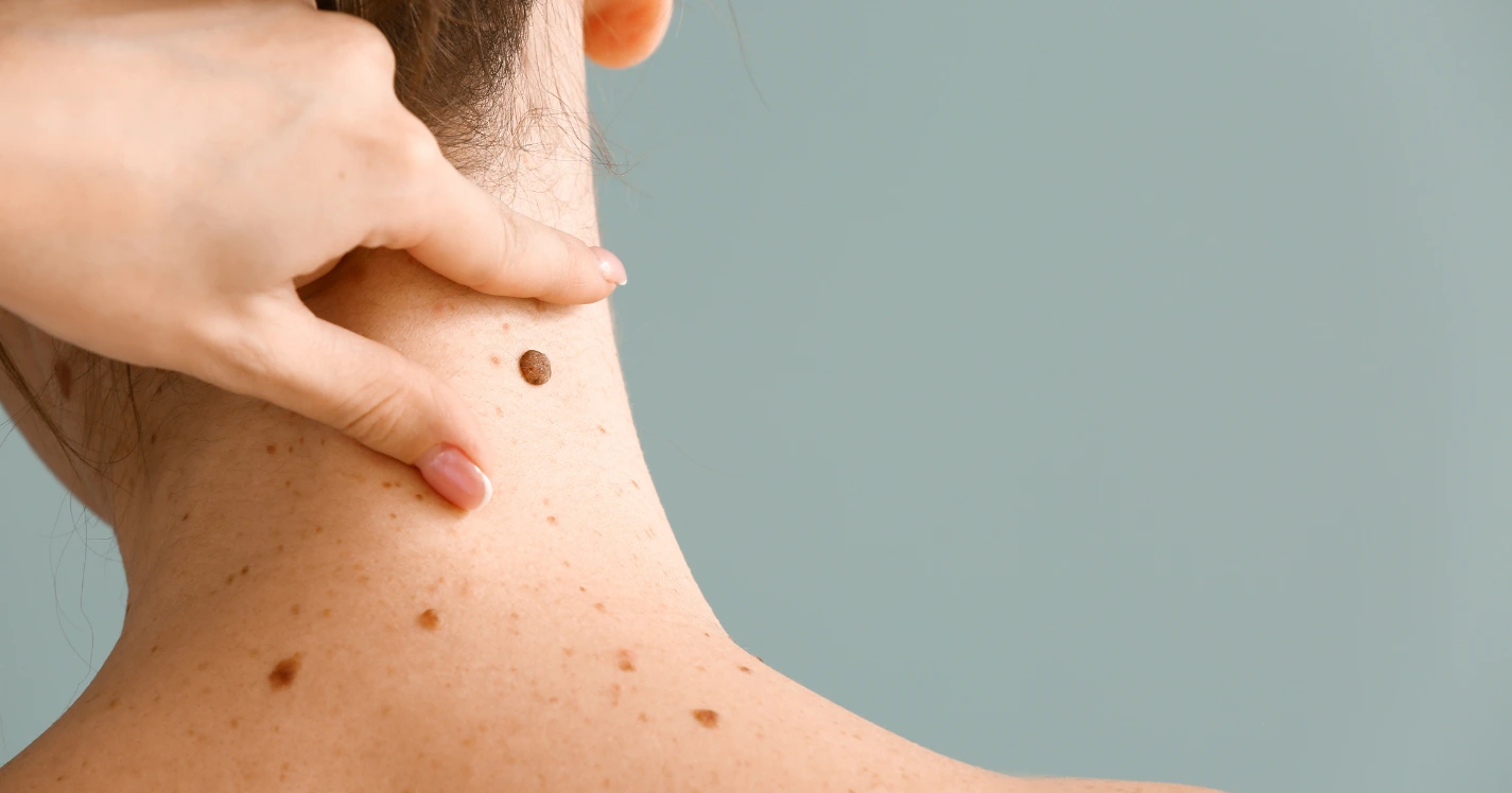 Close-up image of a person’s neck showing multiple moles being examined by a healthcare professional before mole removal