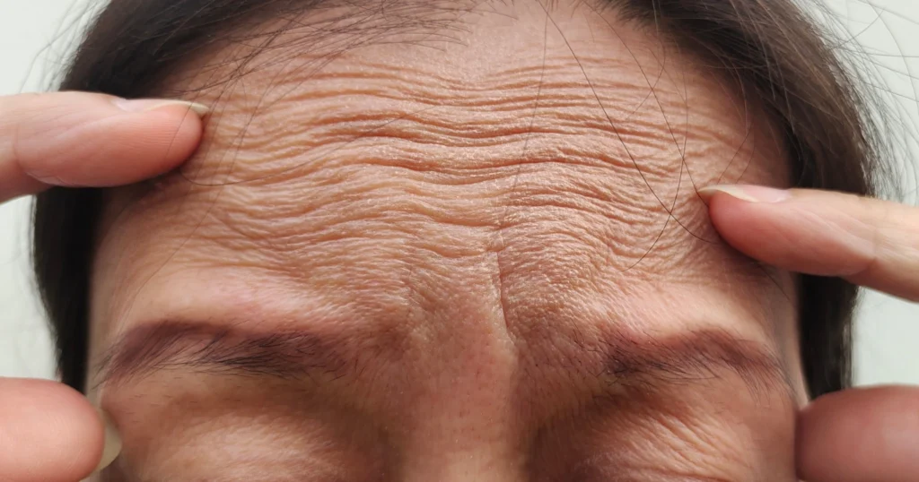 A close image of a patient's forehead showing signs of aged skin